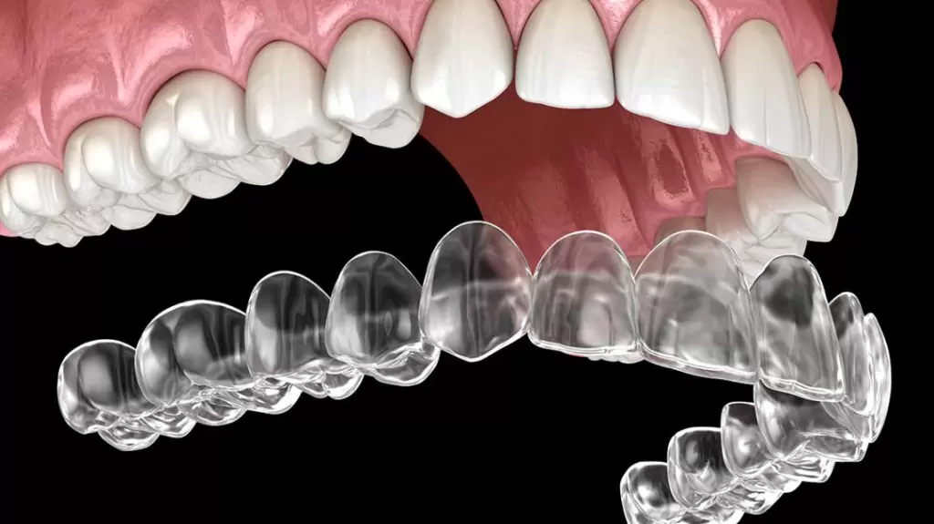invisalign-tedavileri-1024x575-1