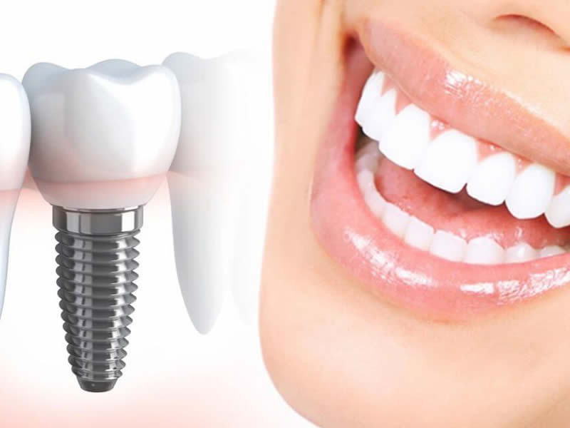 Gülüş Tasarımı (Hollywood Smile)